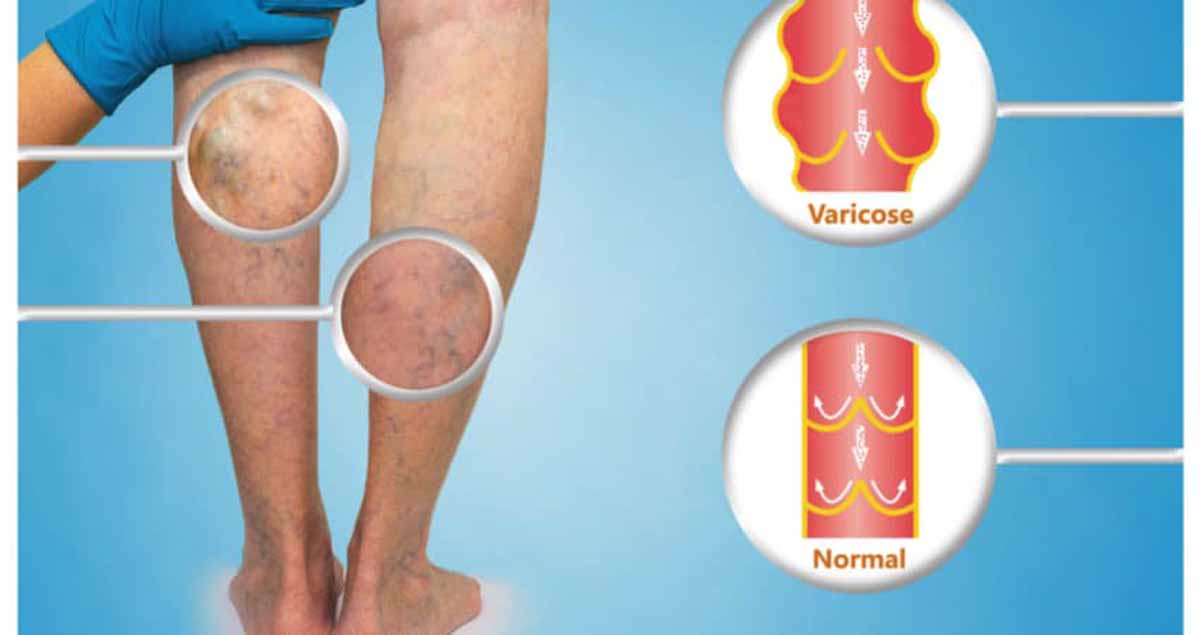 Varicose-Vein